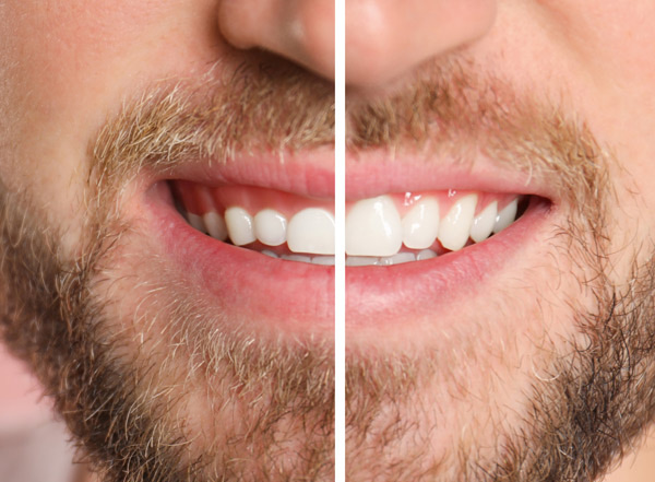 smiling face showing teeth with beard before and after transformation dental improvement and whitening